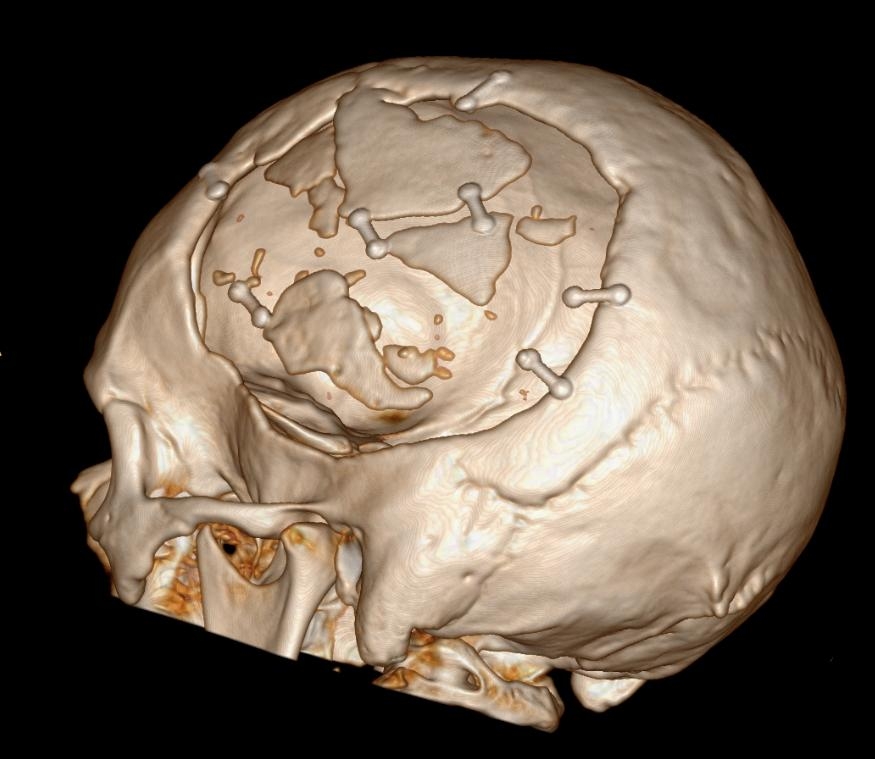 Nieuwe afbeelding schedel