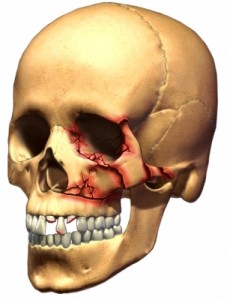 trauma-tand-hoofd-hals-onderkaak-fractuur-breuk-kaak-neus-jukbeen